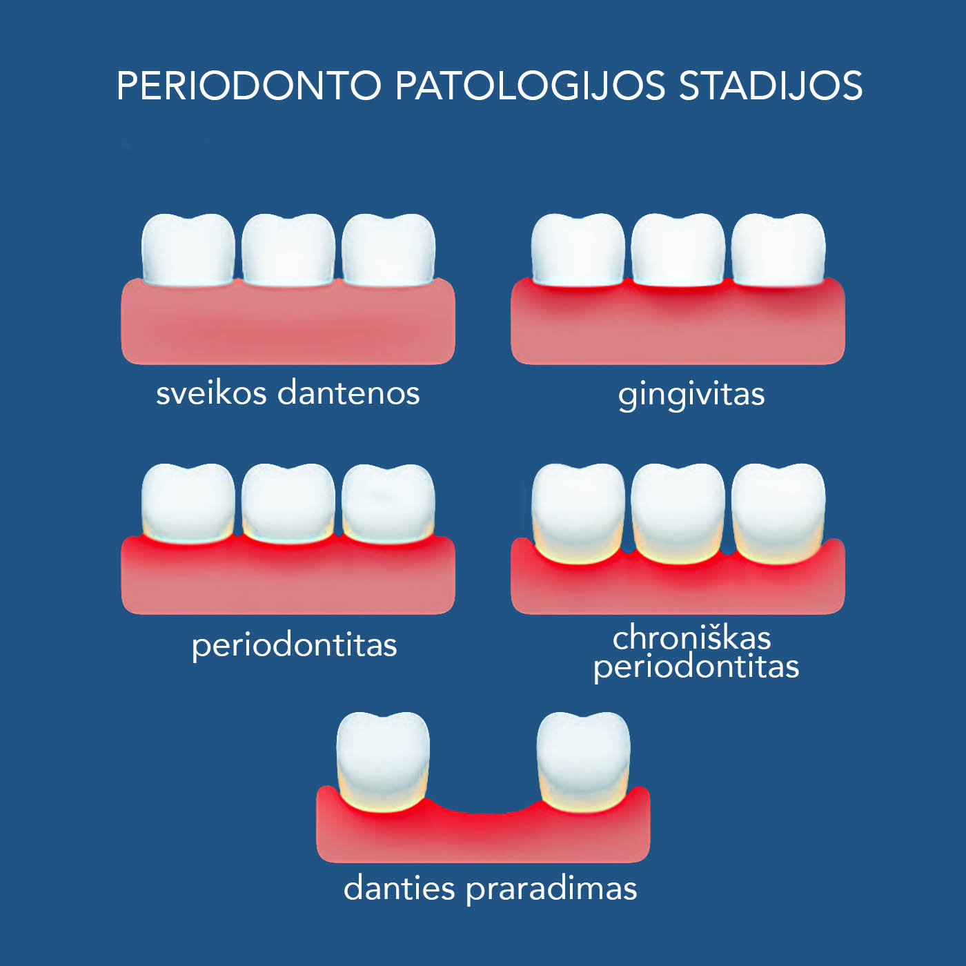 EUDENTA periodontito stadijos